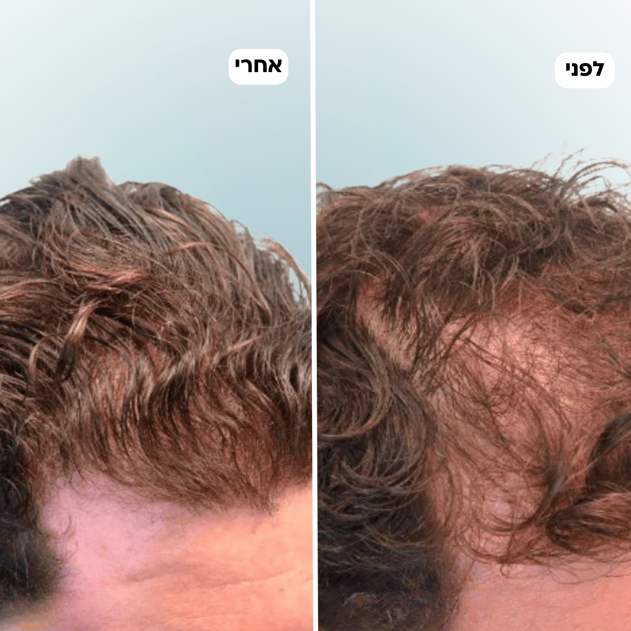 נייצ'ר לי - ערכה לטיפול ושיקום נשירת שיער