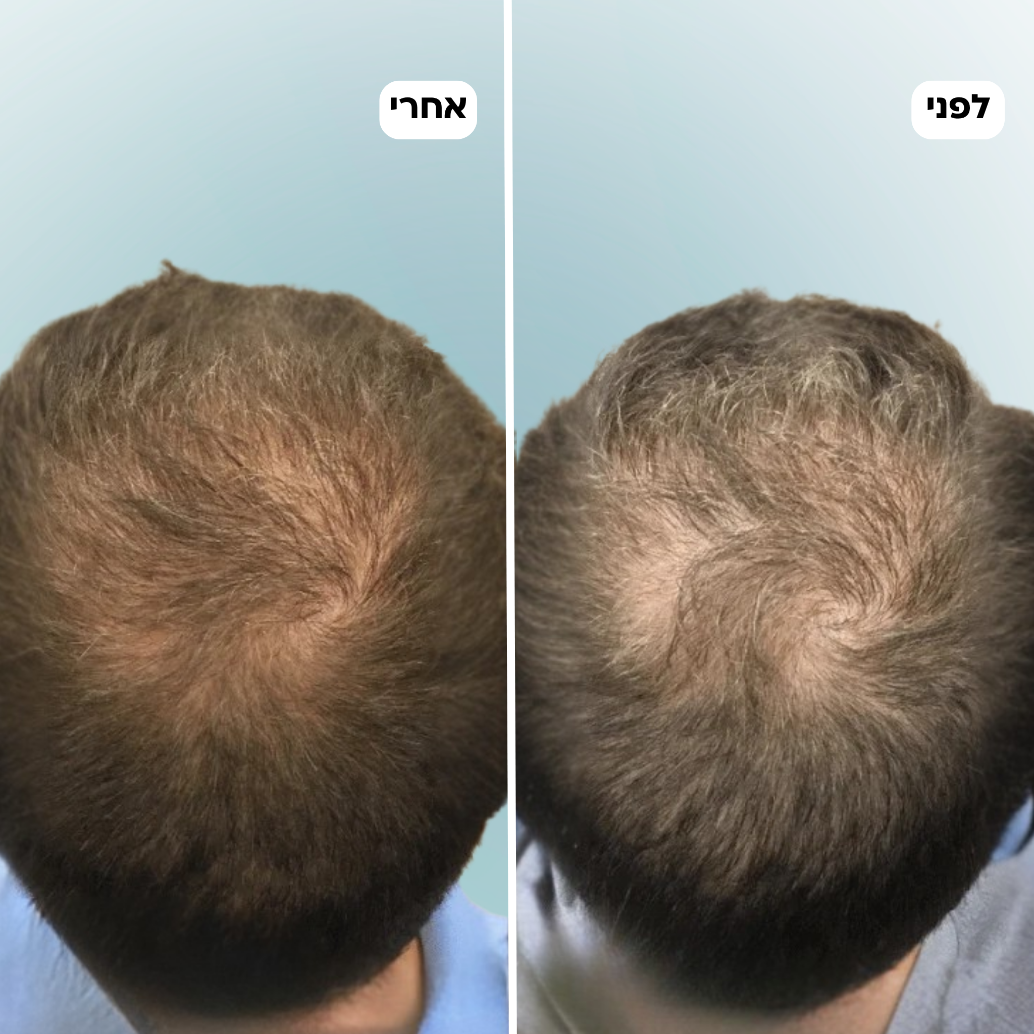 נייצ'ר לי - ערכה לטיפול ושיקום נשירת שיער