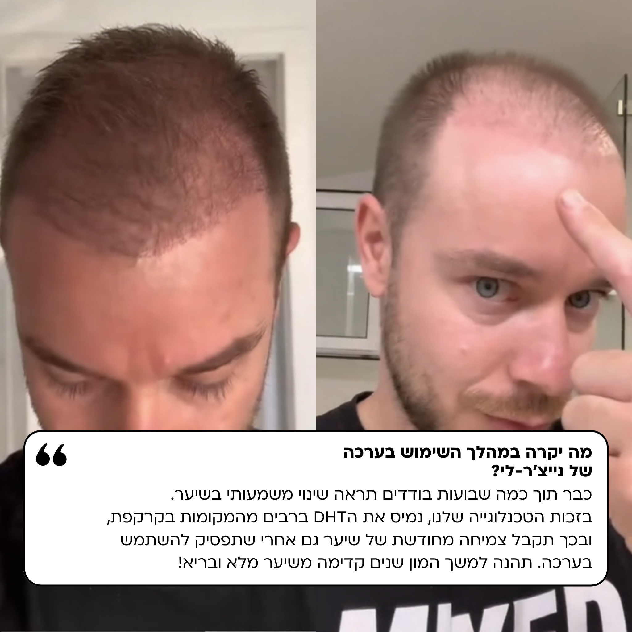 נייצ'ר לי - ערכה לטיפול ושיקום נשירת שיער